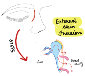 Types of DCR surgeries . External skin incision