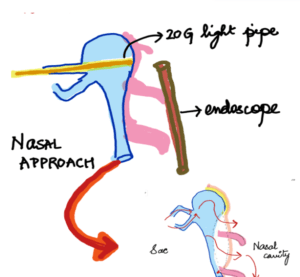 endonasal DCR surgery showing endoscope in the nose and the illumination pipe to the lacrimal sac