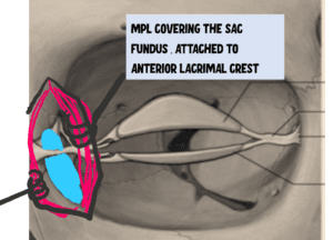 MPL ligament, steps of DCR surgery