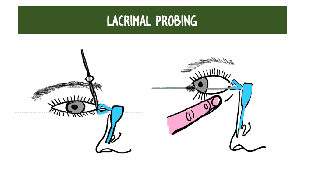 lacrimal probing