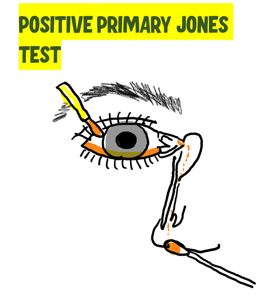 positive primary jones test