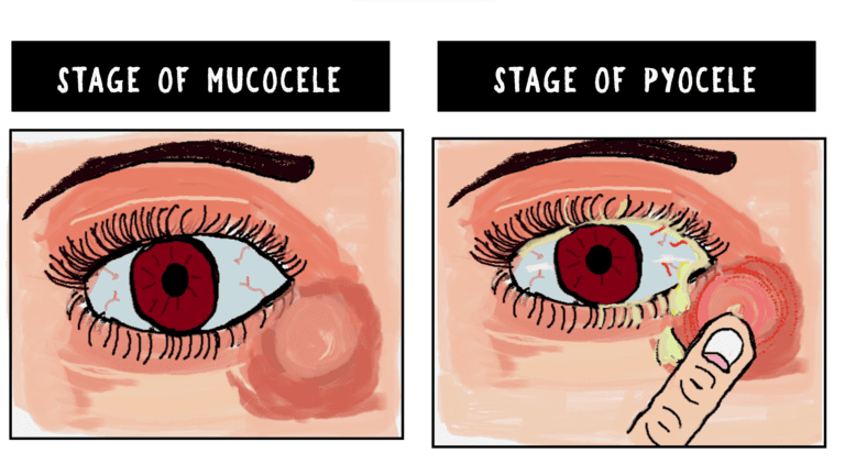 image depicting differences between mucocele and a lacrimal pyocele