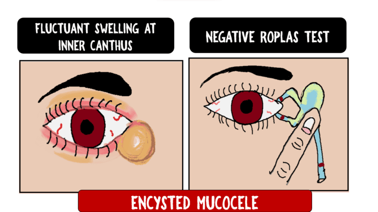 The image depicts what is encysted mucocele? it has large encysted swelling with negative roplas test