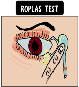 what is roplas test? regurgitation on pressure over lacrimal sac area