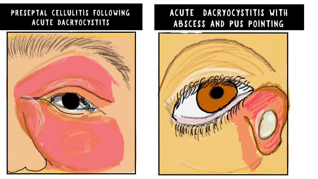 acute dacryocystitis ,lacrimal abcess