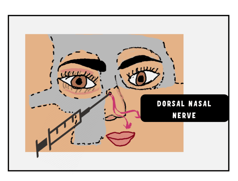 image depicting the dorsal nasal nerve block for lacrimal sac surgeries