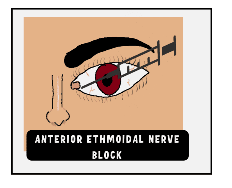 image showing anterior ethmoidal nerve block through transcaruncular approach