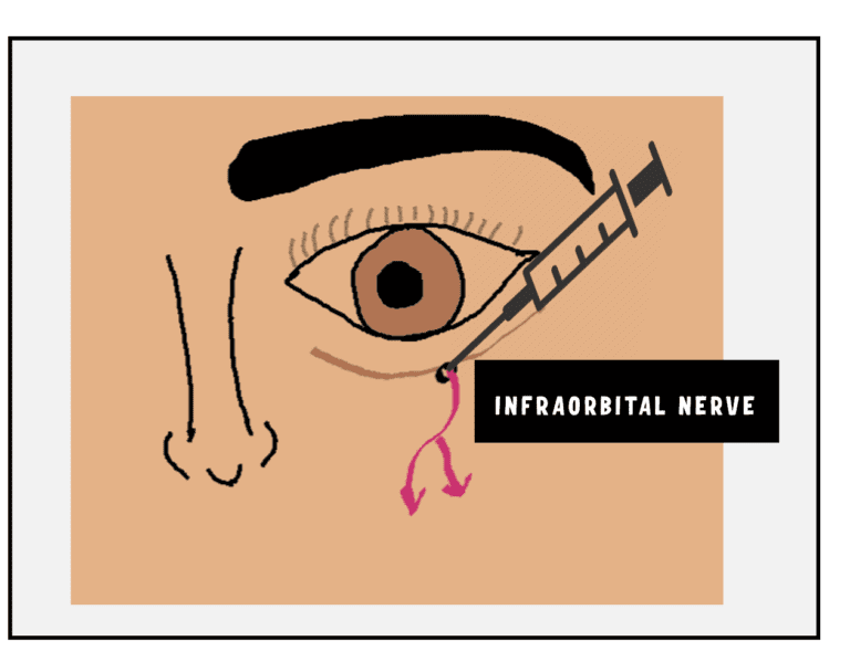 infraorbital nerve is situated 2 cm below the inferior orbital rim in the mid pupillary plane