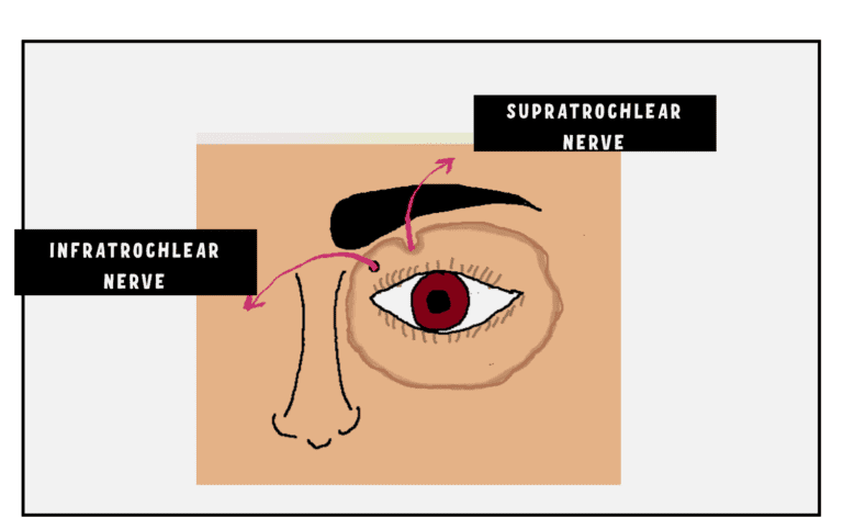 DIAGRAM DEPICTING INFRATROCHLEAR nerve block for lacrimal sac surgery