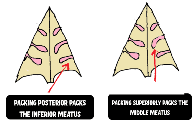 IMAGE depicting the correct direction of the nasal packing