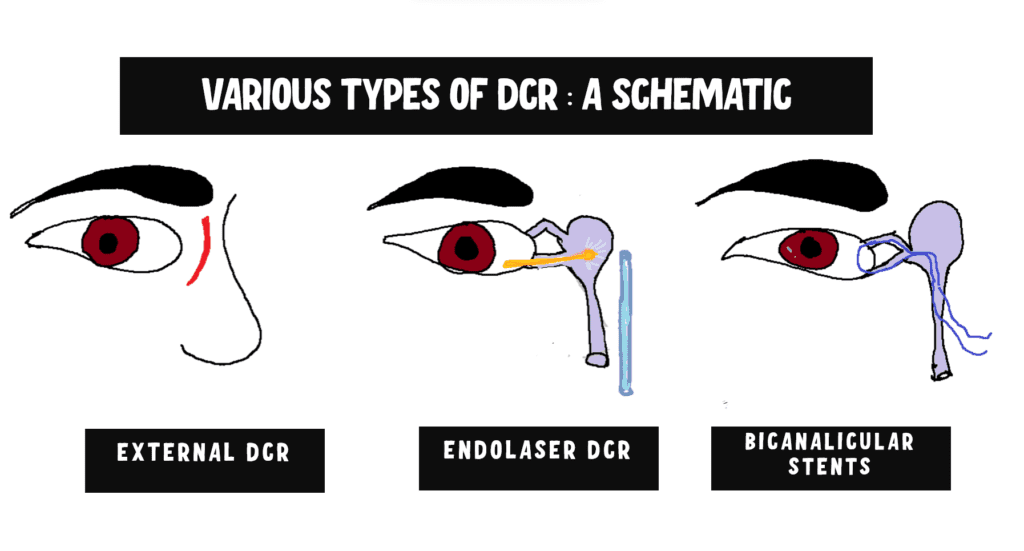 Image showing types of DCR surgeries