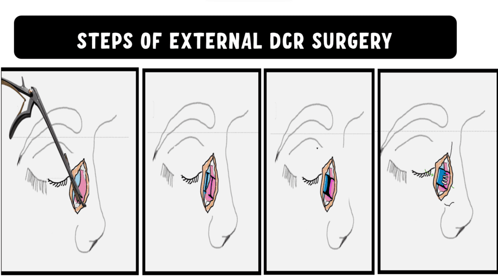 EXTERNAL DCR STEPS