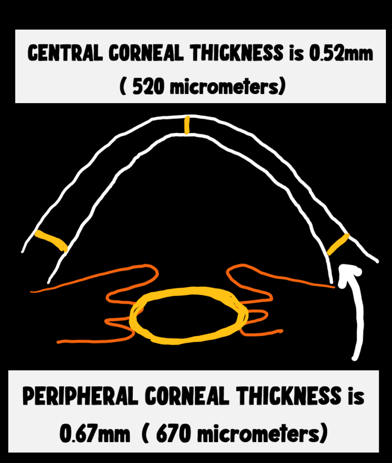 image depicting the variation in corneal thickness. the central corneal thickness average and peripheral corneal thcikness