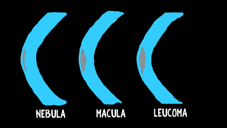 different types of corneal scars ,namely nebular scar of cornea, macular scar of cornea and leucomatous scar of cornea