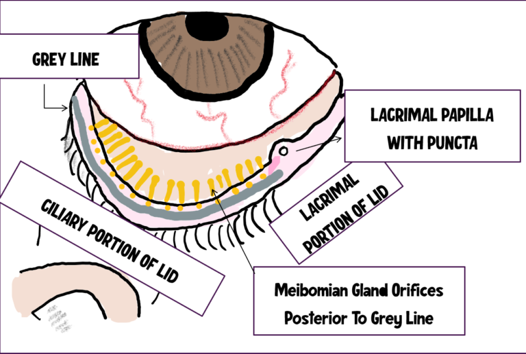 the image depicts the anatomy of eyelid margin.The eyelid margin is divided into two parts, pars ciliaris and pars lacrimalis by the lacrimal punct