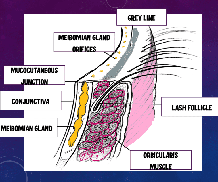 image depicting the anatomy of the eyelid margin, meibomian glands, grey line