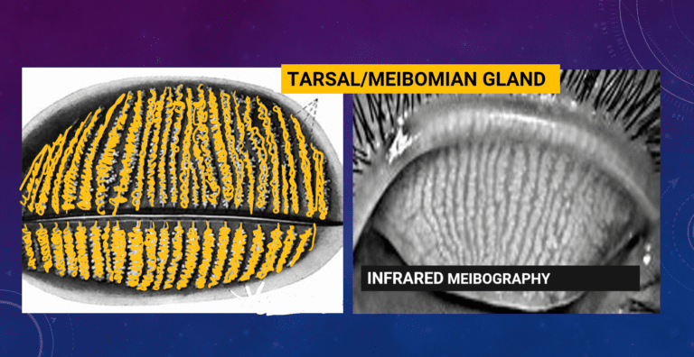 image showing the meibomian glands embedded in the tarsus