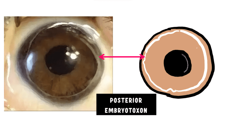 image showing posterior embryotoxon which is anteriorly displaced schwalbes line