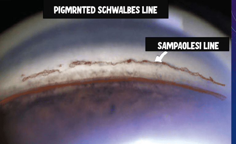 image showing the sampaolesi line, which is the pigmented schwalbes line