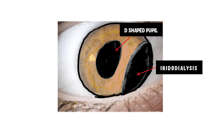 image showing IRIDODIALYSIS and D shaped pupil in iridodialysis