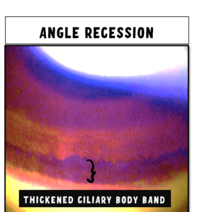 image showing enlarged ciliary body band in angle recession