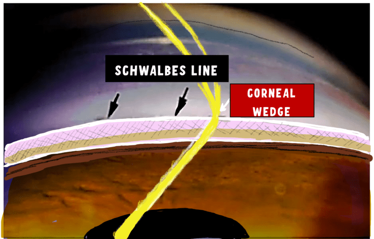 image showing the Schwalbes line and the corneal wedge useful in its identification