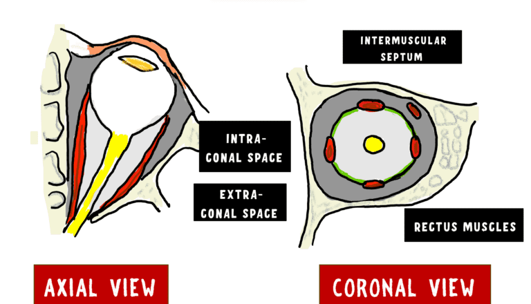 image depicting the recti muscles with the intermuscular septum forming the intraconal and extraconal space of orbit