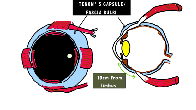 Image showing the fascial covering of the eyeball known as the fascia bulbi or the tenons capsule. It originates from the sheath of the optic nerve and is inserted at the limbus