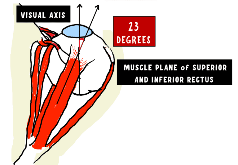 image depicting the course of superior and inferior rectus and their insertion. the image depicts the angle between the visual axis and the superior and inferior muscle axis is 23 degrees