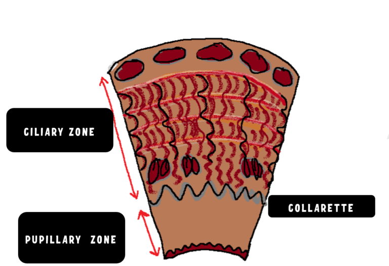 Image showing the iris is divided into two zones by the collarette , namely the ciliary zone and the pupillary zone