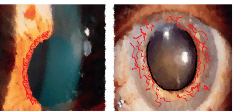 image showing new vessels near pupillary margin and iris