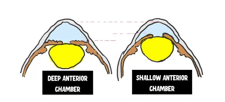 image showing comparison of deep and shallow anterior chamber