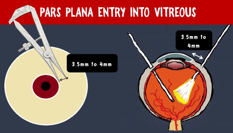 image showing pars plana entry site into the vitreous cavity is 4mm from limbus in phakic eye.