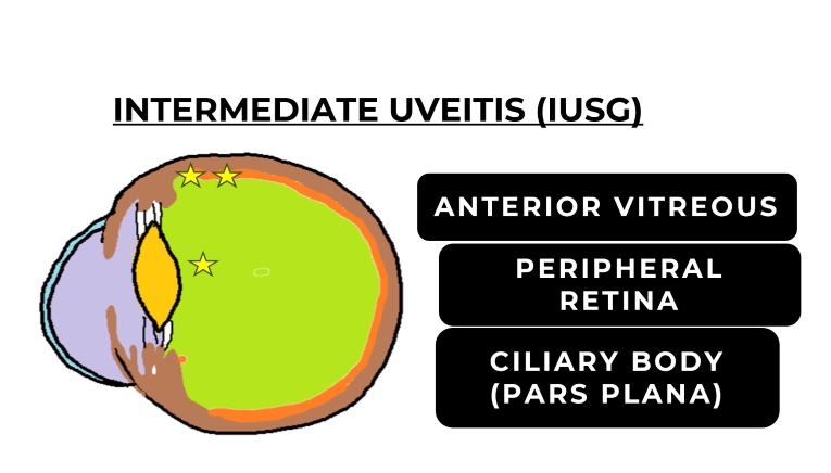 image depicting the site of inflammation in intermediate uveitis