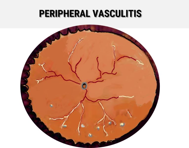Fundus photograph of peripheral periphlebitis in intermediate uveitis