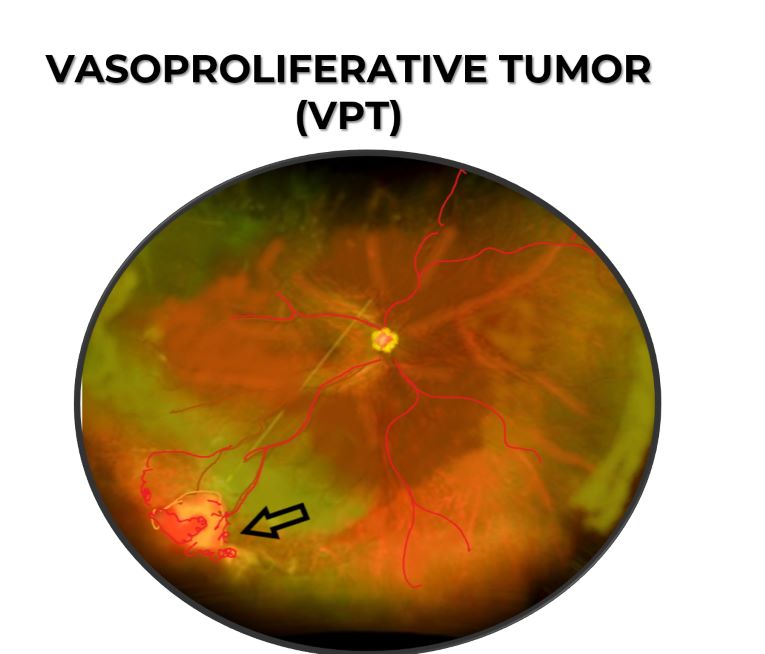 daigramatic represntaion of vasoproliferative tumor in intermediate Uveitis