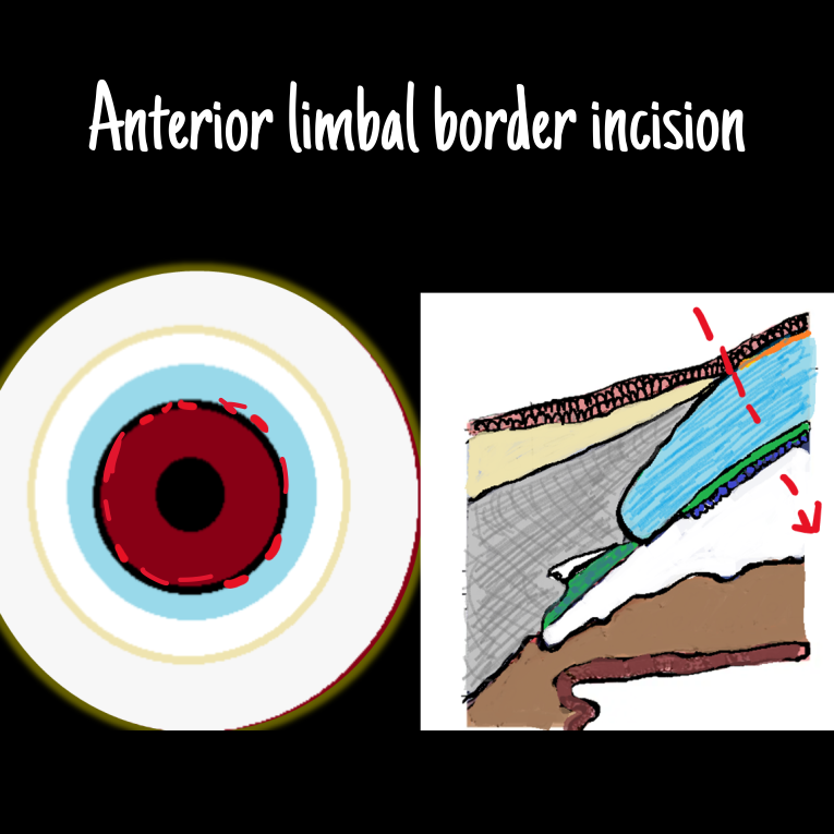 Diagram depicting anterior limbal border incision passing through DM into the anterior Chamber