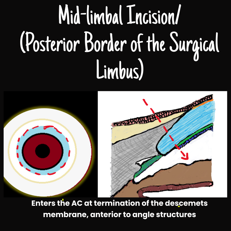 diagram depicting the effect of an incision at the mid-limbal border or the posterior limit of the surgical limbus