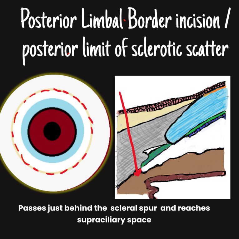 diagram depicting incision through the posterior limbal border
