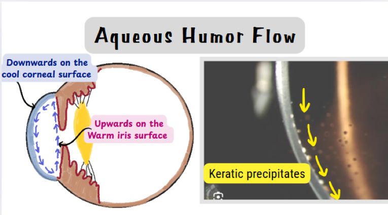 Illustration showing aqueous humor convection currents in the anterior chamber—downward flow over the corneal endothelium due to cooler avascular cornea and upward flow over the vascular iris, with keratic precipitates deposited inferiorly on the corneal endothelium.