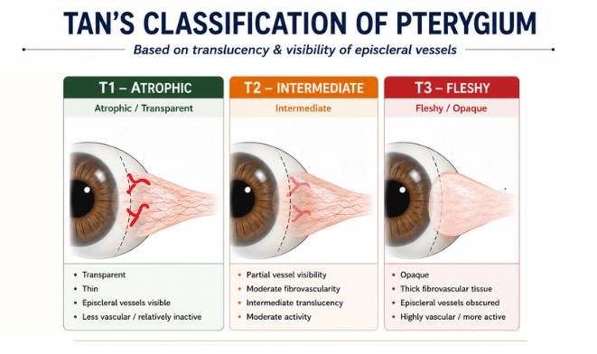 Diagram showing Tan classification of pterygium based on translucency and visibility of episcleral vessels