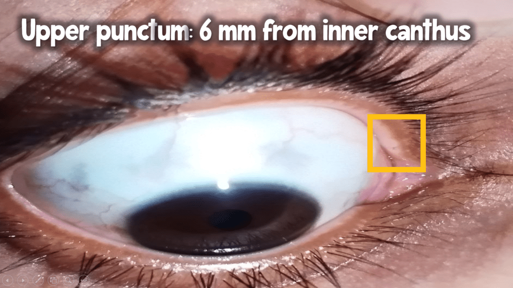 upper punctum location