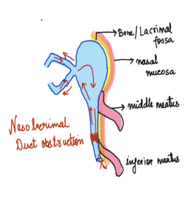 DCR surgery, NAsolacrimal duct blockage, watering , epiphora