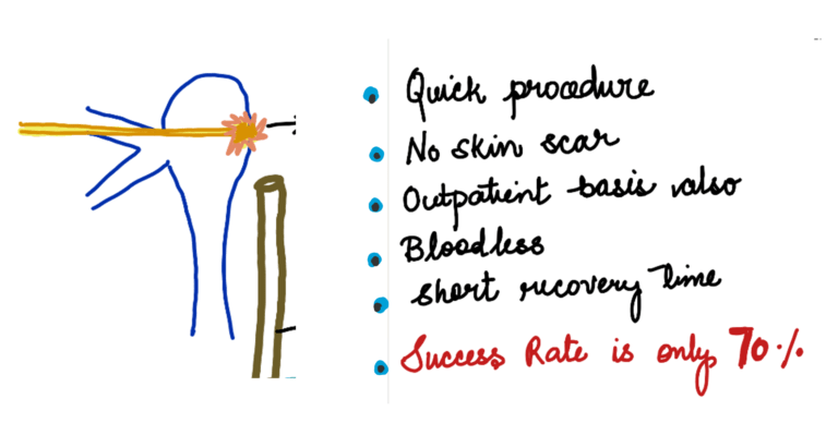 types of DCR surgeries : endocanalicular laser DCR