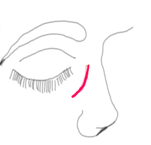 DCR skin incision