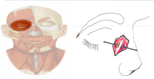 blunt dissection of orbicularis steps of DCR surgery