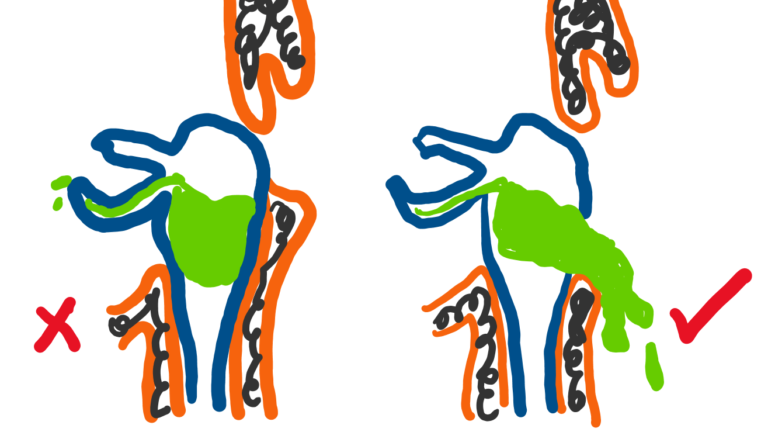image depicting how inadequate osteotomy inferiorly can lead to a sump syndrome