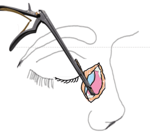 EXTERNAL DCR steps :bony ostium formation