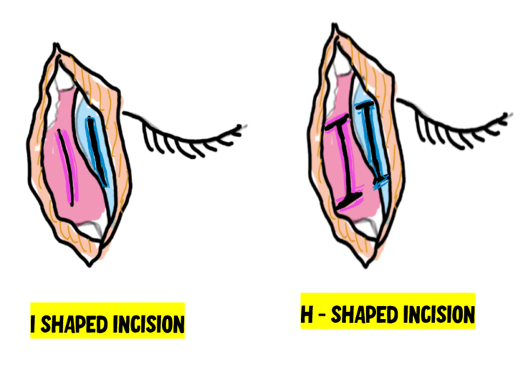 flap creation DCR
