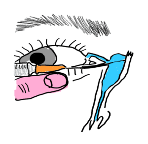 lacrimal syringing